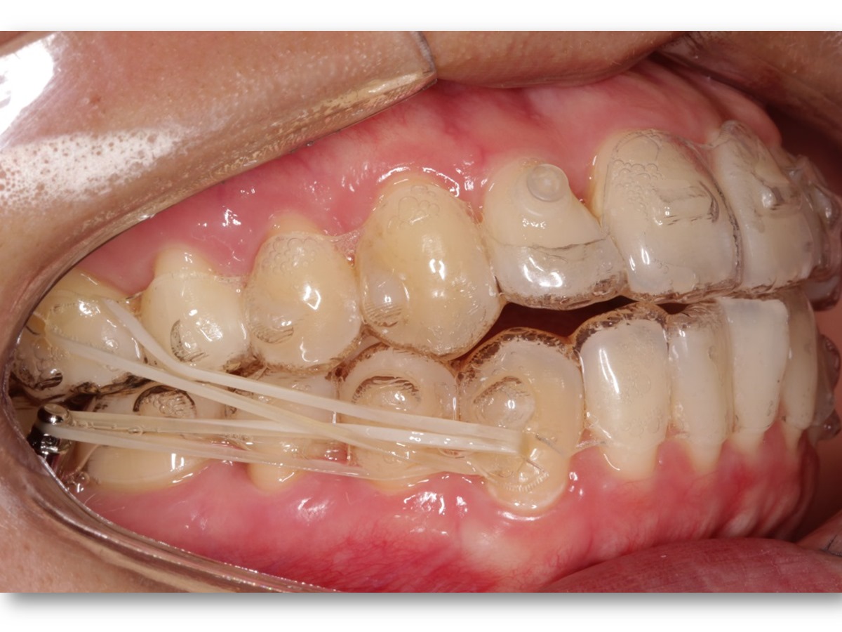 Residência em Alinhadores Invisalign